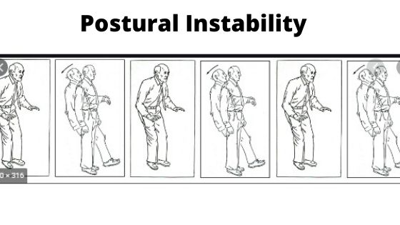 Postural Instability -symptoms-of-parkinson-disease