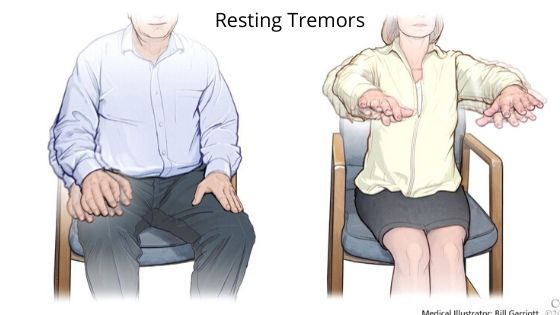 Resting Tremors-symptoms of Parkinson's disease