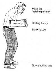 bradykinesia-symptom-of-parkinson's disease