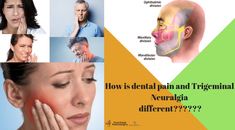 How-is-dental-pain-and-Trigeminal-Neuralgia-different