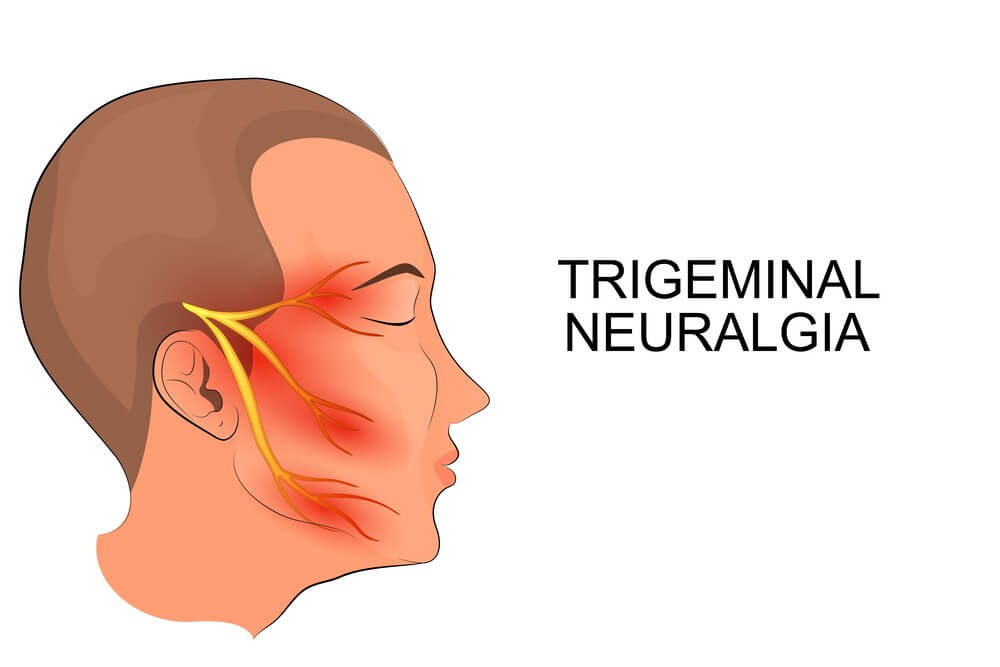 Causes, Symptoms, and Diagnosis for Trigeminal Neuralgia