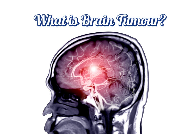 WHAT IS BRAIN TUMOUR