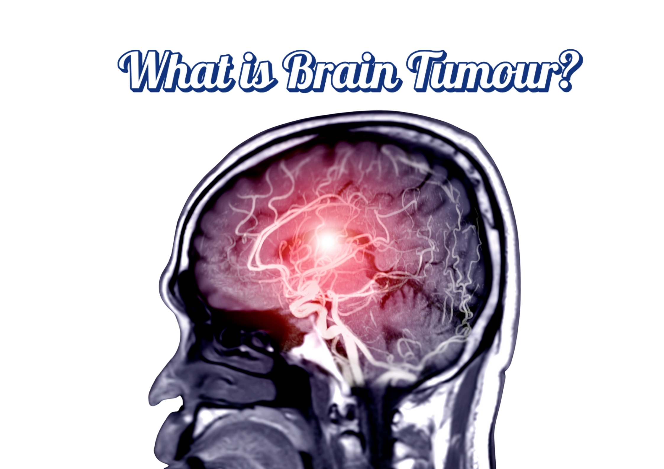 WHAT IS BRAIN TUMOUR