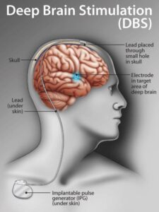 deep brain stimulation mumbai
