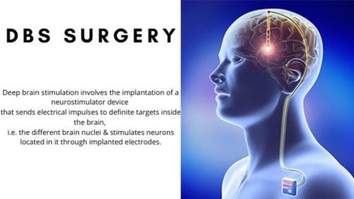 DBS surgery DBS surgery